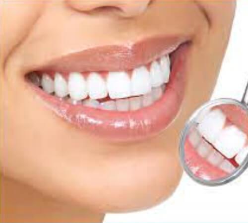  Smile Veneers