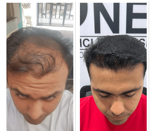 Best Hair transplant clinic in Hyderabad