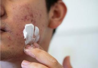 Best Acne Treatment in Hyderabad Best Acne Treatment in Hyderabad