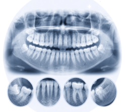 OPG XRay