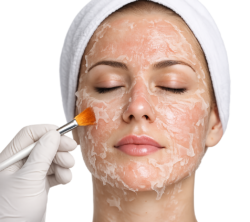chemical peel